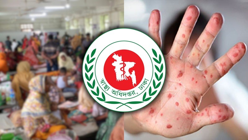 ২৪ ঘণ্টায় হামের উপসর্গে ৭ জনের মৃত্যু, হাসপাতালে ভর্তি ১,৩২৭